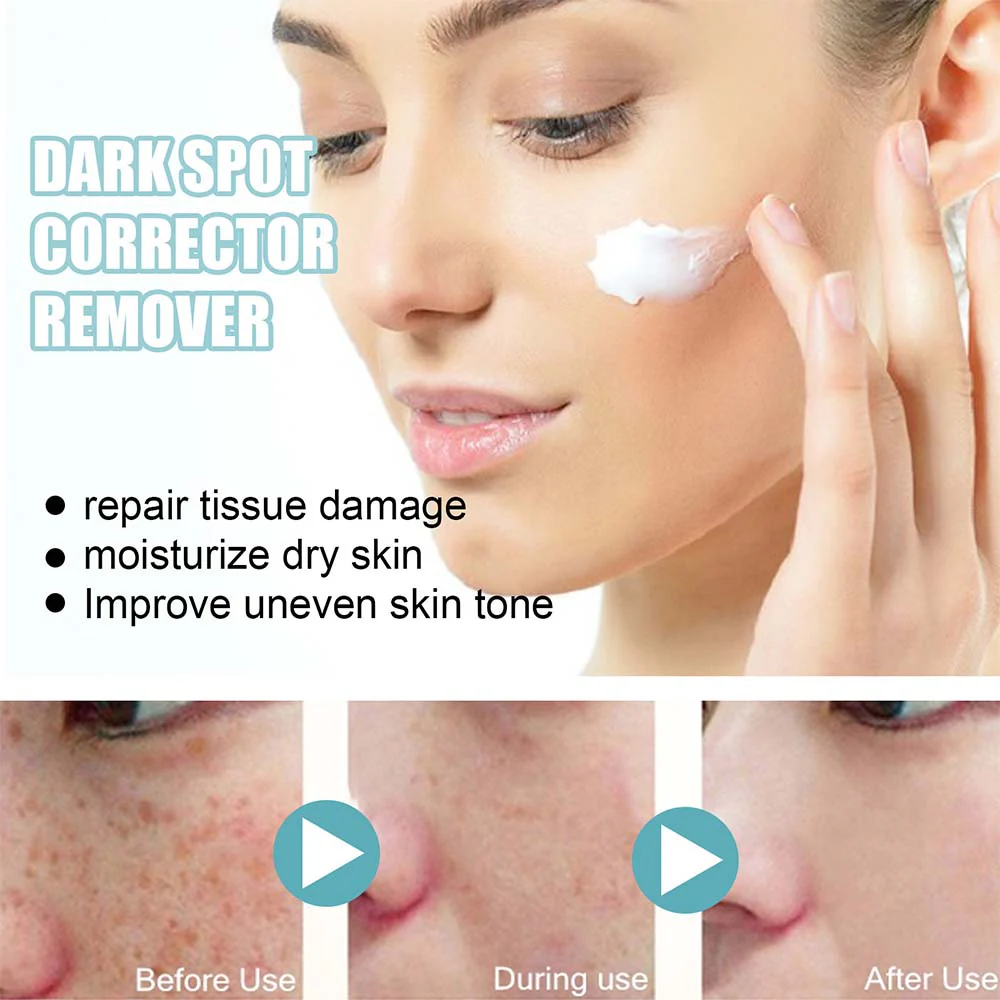 Anti-Dark Spot Skin Care Lightens Pigmentation Spots - Image 3