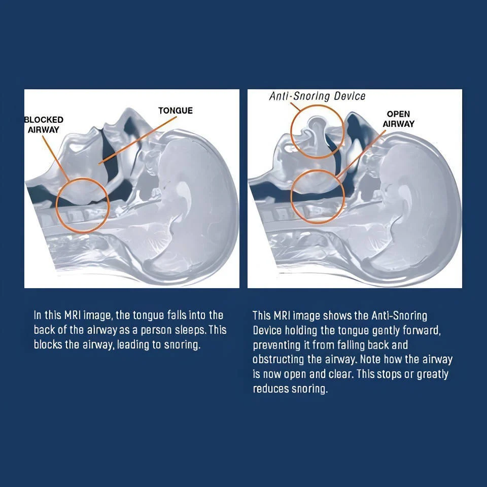 Sleep Apnea Tongue Retainer, Non-Invasive Snoring Relief Aid - Image 4