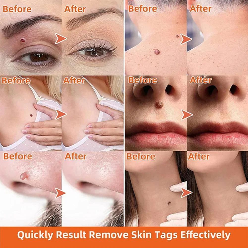 Auto Skin Tag Remover Painless - Image 2