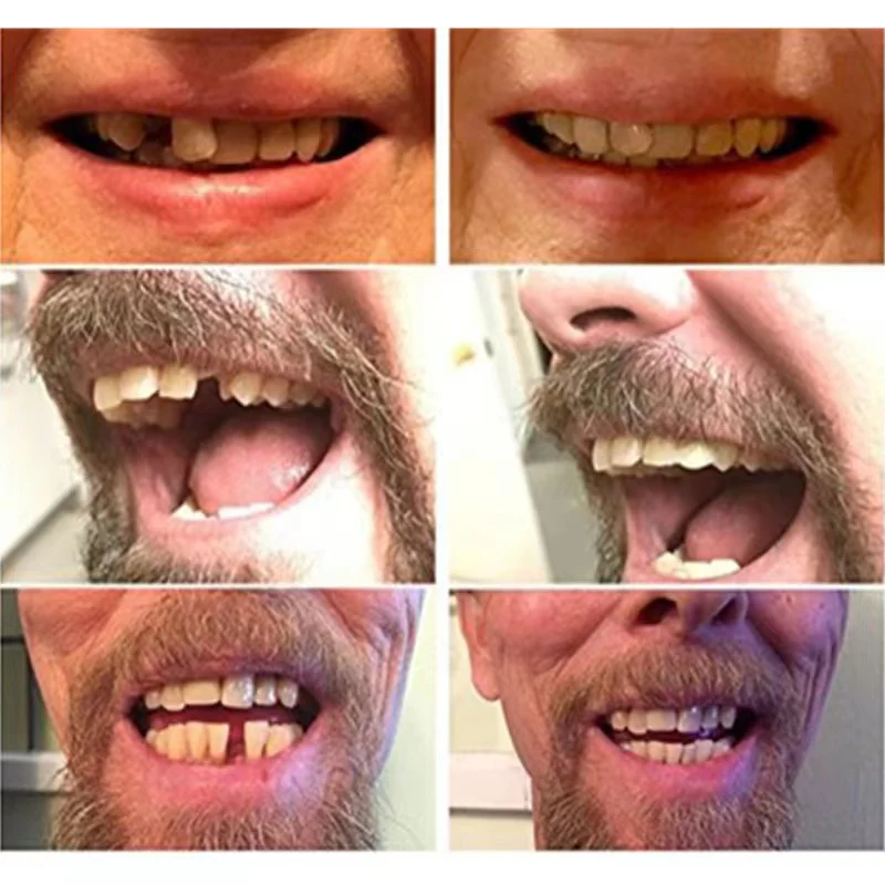 High-Quality False Teeth - Image 3
