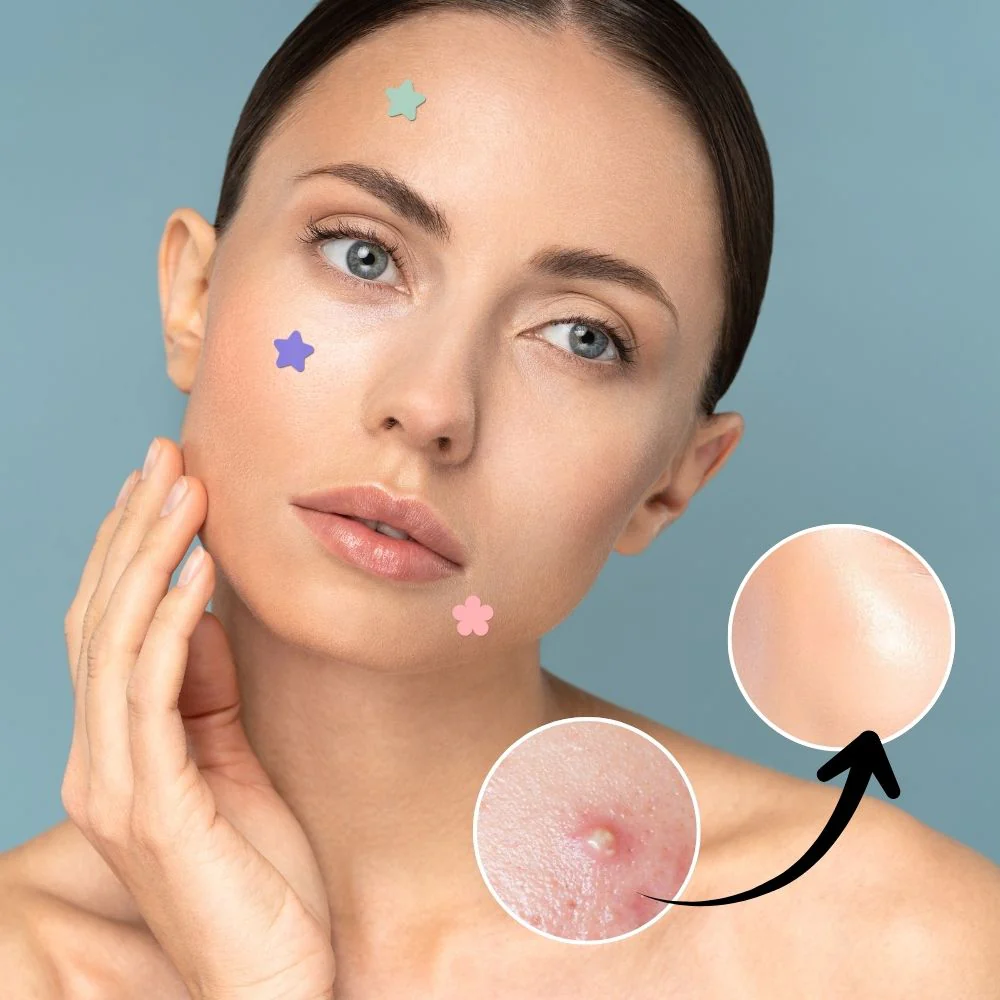 Hydrocolloid Pimple Acne Patch Sticker - Image 3