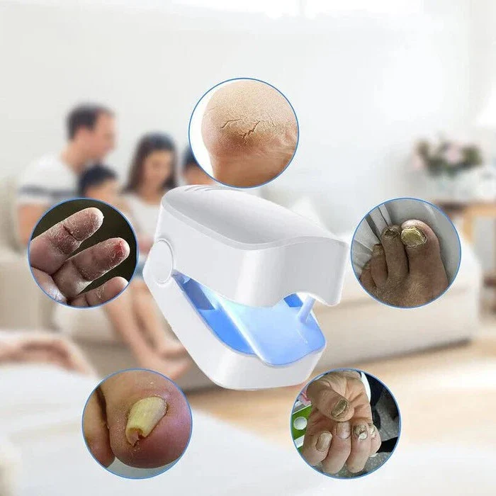 Nail Fungus Cleaning Laser Device - Expert Revolutionary High-Efficiency Light Therapy Device For Toenail Diseases - Image 2