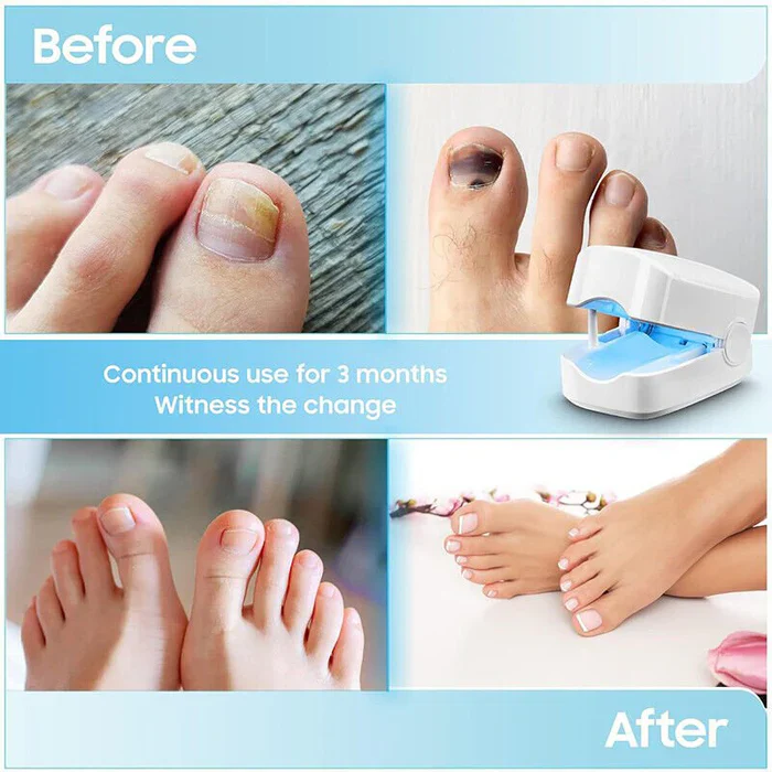 Nail Fungus Cleaning Laser Device - Expert Revolutionary High-Efficiency Light Therapy Device For Toenail Diseases - Image 4