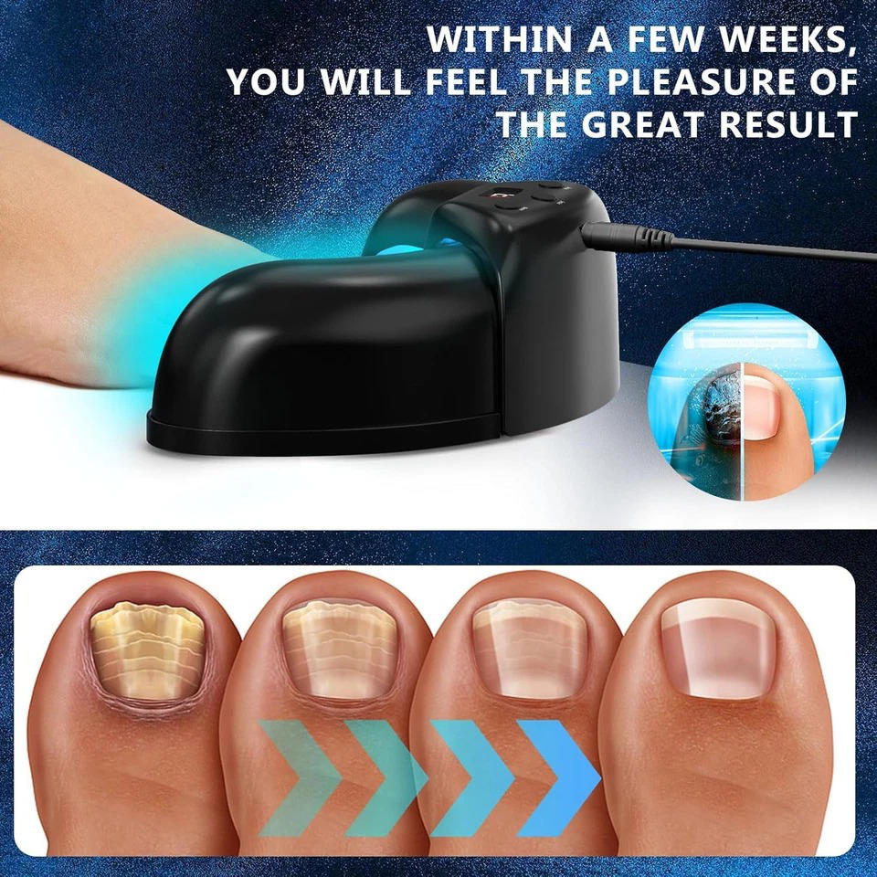 Nail Fungus Laser - Image 14