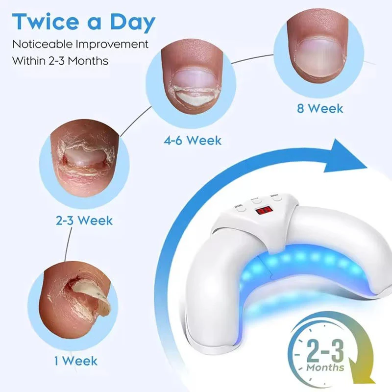 Nail Fungus Laser - Image 3