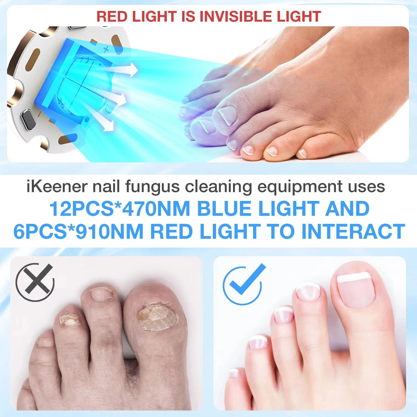 Nail Fungus Laser - Image 4