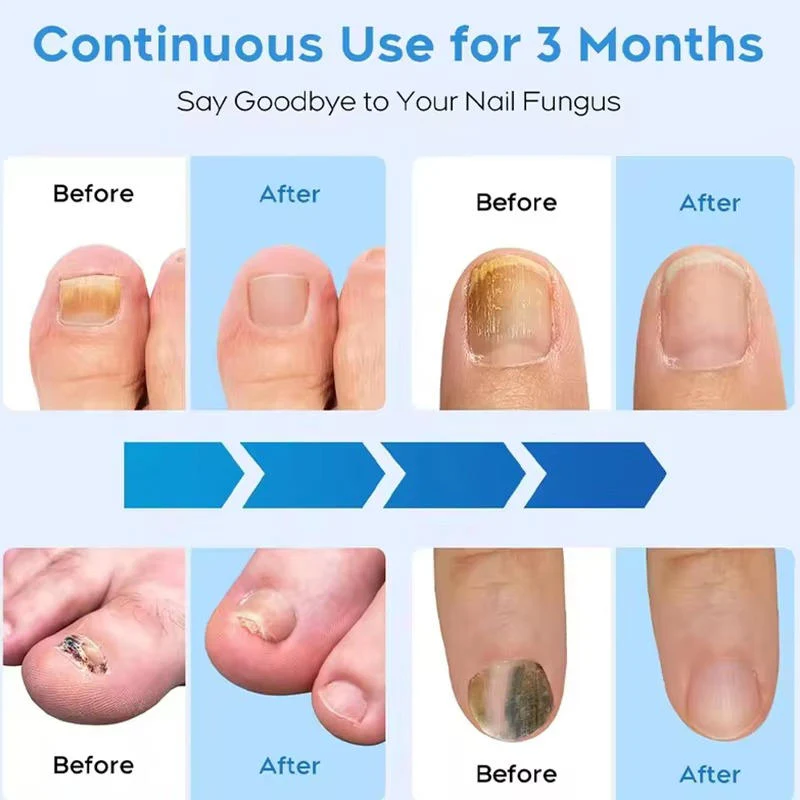 Nail Fungus Laser - Image 5