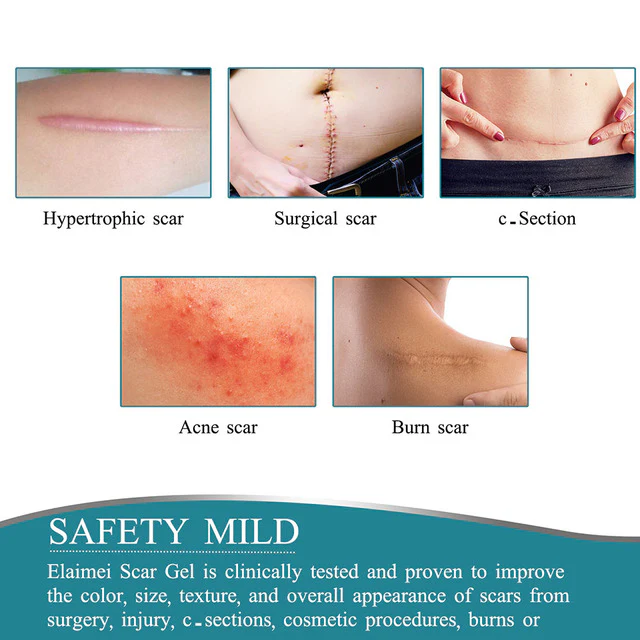 Silicone Scar Tape Roll - Image 2