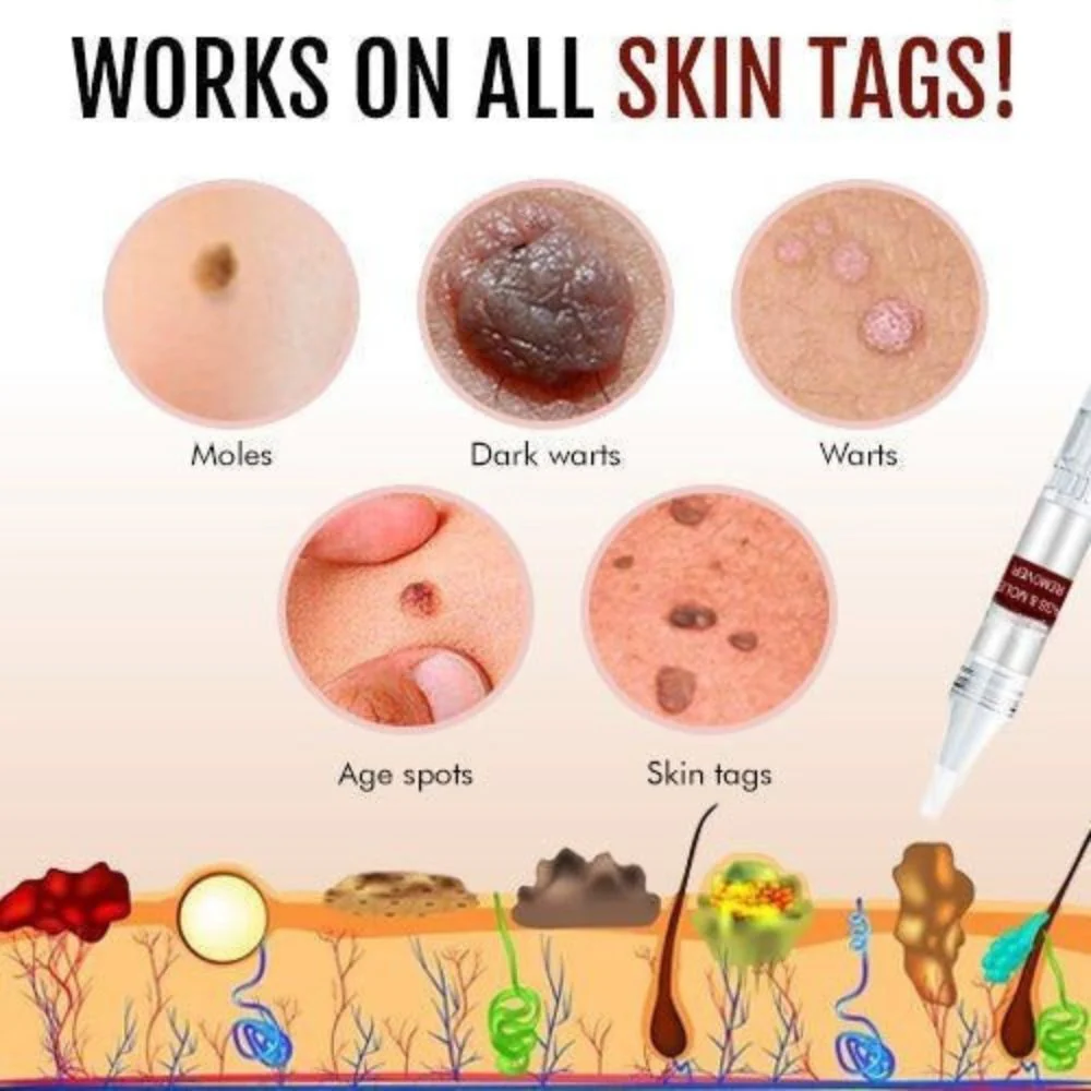 Tags & Moles Remover - Image 2
