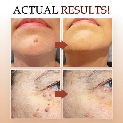 Tags & Moles Remover - Image 4