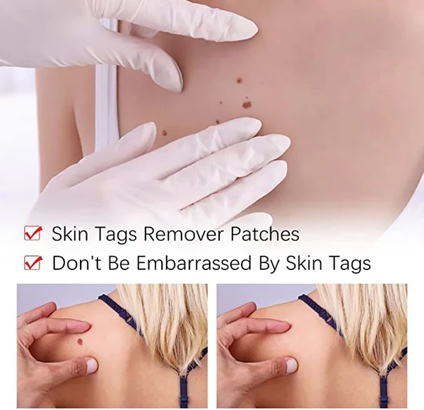 Tags & Moles Remover - Image 5