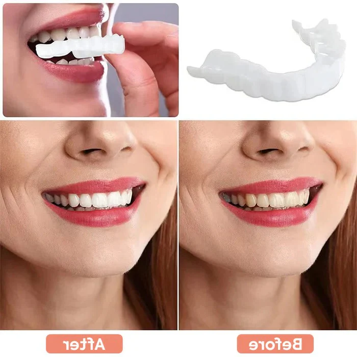 Veneers for Teeth with Natural White Finish - Image 6